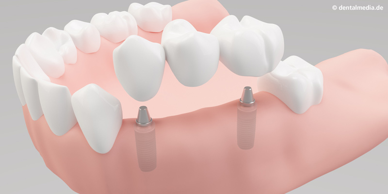Implantologie : Mehrere Zähne fehlen  Die fehlenden Zähne werden durch Implantate ersetzt, auf die eine Brücke aufgesetzt wird. Nachbarzähne bleiben voll erhalten.