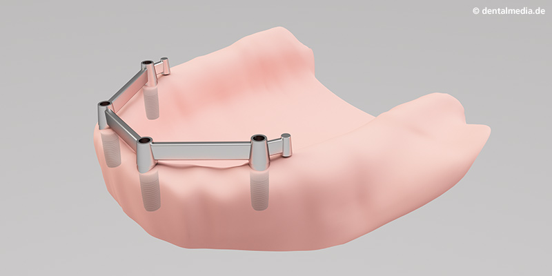 Vollprothesen : Befestigung der Stege zwischen den zuvor gesetzten Implantaten Vollprothesen : Befestigung der Stege zwischen den zuvor gesetzten Implantaten