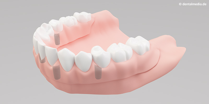 Vollprothesen : Ästhetisch anspruchsvolles Endergebnis mit herausnehmbarer Vollprothese Vollprothesen : Ästhetisch anspruchsvolles Endergebnis mit herausnehmbarer Vollprothese